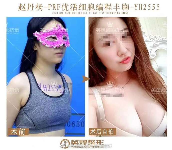 梁耀婵自体脂肪丰胸案例